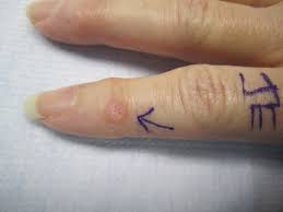 photos of mucous cysts in fingers