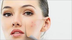 quick fix solutions to cure acne