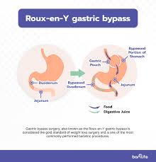 gaining weight after gastric byp