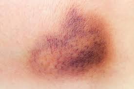 bruise home remes 5 methods to get