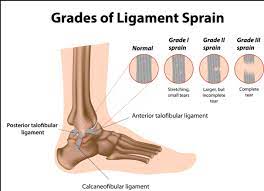Patients with a grade ii sprain have significant swelling and pain. Ankle Pain You May Have A Lateral Sprain