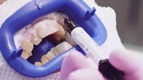 Image result for why do dentist use pins when doing a root canal