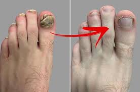 how to get rid of toenail fungus with
