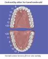 Hull i tennene: Vanligere at barn har mange hull i tennene. Tenner