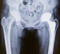 hip replacement surgery how it works