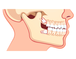home remes to relieve wisdom tooth pain