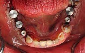 extraction dental implant it won t