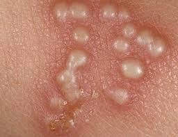 Overview hsv infections can be very annoying because they can periodically reappear. Herpes Rmi