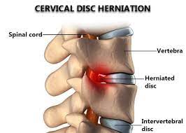 cervical disc herniation treatment in