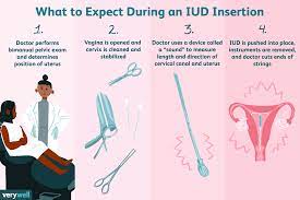 iud insertion what to expect