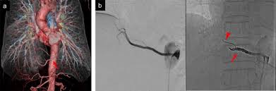 Lessons learned from hybrid surgery with preoperative coil embolization for  an aberrant artery in pulmonary sequestration | Surgical Case Reports | Full  Text