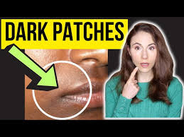 dermatologist explains dark patches