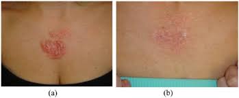 hypertrophic pigmented and acne scars