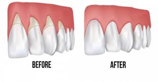How to remineralize teeth to recap, the things that drs. Strengthening Weak Gums My Dentist Burbank