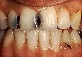 Kandungan nikotin dalam rokok akan membuat gigi kehilangan warnanya dan akan menghitam. 99 Arti Mimpi Melihat Gigi Hitam Menurut Primbon Jawa Dan Tafsir Islam Lengkap Mimpi Gigi
