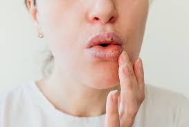 7 home remes for swollen lips