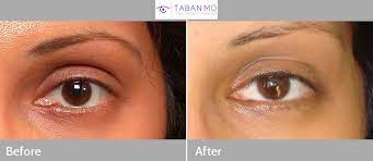 eyelid chalazion surgery before and