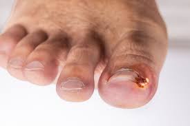 ingrown toenail infection symptoms