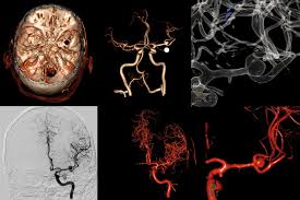 O aneurisma cerebral é uma dilatação localizada de uma pequena porção de uma artéria por isso, o sangramento de um aneurisma cerebral é genericamente chamado também de hemorragia. Hospital Italiano De Buenos Aires