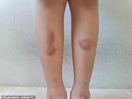 Ask The Gp How Can My Wife Stop The Bruising On Her Shins