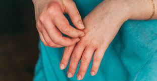 7 types of eczema symptoms causes