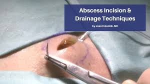 abscess incision drainage techniques