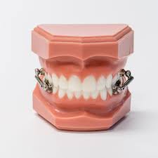 Since overbites are a misalignment of how the teeth and jaws fit together, an orthodontic specialist is typically best suited to address them. Herbst Appliance Can Often Correct Severe Overbites Without Braces