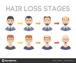 Information Chart Of Hair Loss Stages Types Of Baldness