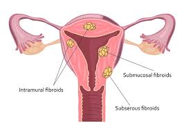 Imagini pentru fibrom uterin