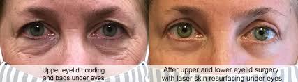 lower eyelid bag removal