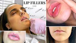 getting lip fillers for the first time