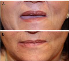 fillers in lip reconstruction