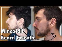 Similar results were observed in clinical tests for women. Minoxidil Beard Growth Three Months Youtube