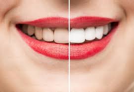 You can use strawberries, baking soda, orange peel, and also you can read other article in this site about how to use lemon juice as teeth whitener. How To Get Whiter Teeth Four Top Tips To Help Achieve A Brighter Smile The Independent The Independent