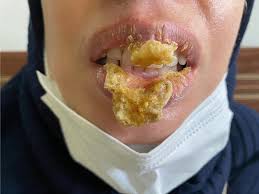 fusarium induced chronic lip ulcer