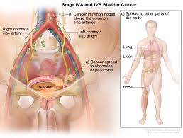 Bladder Cancer Treatment Pdq Health Professional Version