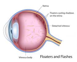 what are flashes and floaters