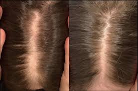 advanced hair restoration tackle hair