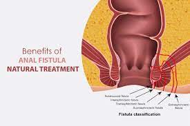 benefits of fistula natural
