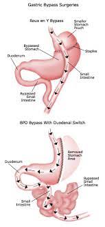 bariatric gastric byp explained