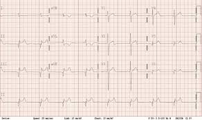 Abnormal Ecg Findings In A Young Patient With Unexplained