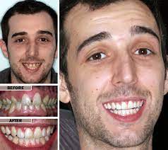 Retainers are usually used to maintain the alignment of teeth after you wear braces, but for small adjustments, a retainer may be able to do the trick. Teeth Straightening In Brooklyn Straighten Teeth Without Braces