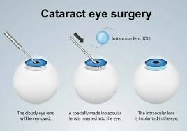 lens implants for cataract surgery