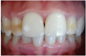 Find out what causes fluorosis or dental fluorosis. Challenge Of Smile Rehabilitation In Case Of Dental Fluorosis Medcrave Online