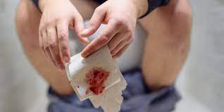 blood in stool 15 reasons for cause of