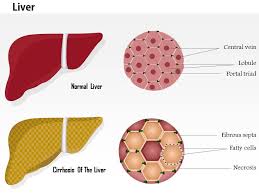 Cirrhosis, also known as liver cirrhosis or hepatic cirrhosis, is the impaired liver function caused by the formation of scar tissue known as fibrosis, due to damage caused by liver disease. 11832124 Style Medical 3 Histology 1 Piece Powerpoint Presentation Diagram Infographic Slide Presentation Powerpoint Images Example Of Ppt Presentation Ppt Slide Layouts