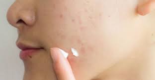 remove acne scars sentinelam
