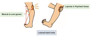 pain behind the knee kasahara foot care