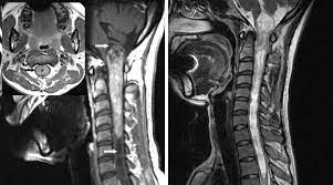 intramedullary spinal cord tumor the