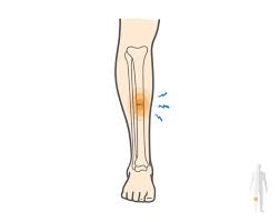 what is a stress fracture of the tibia